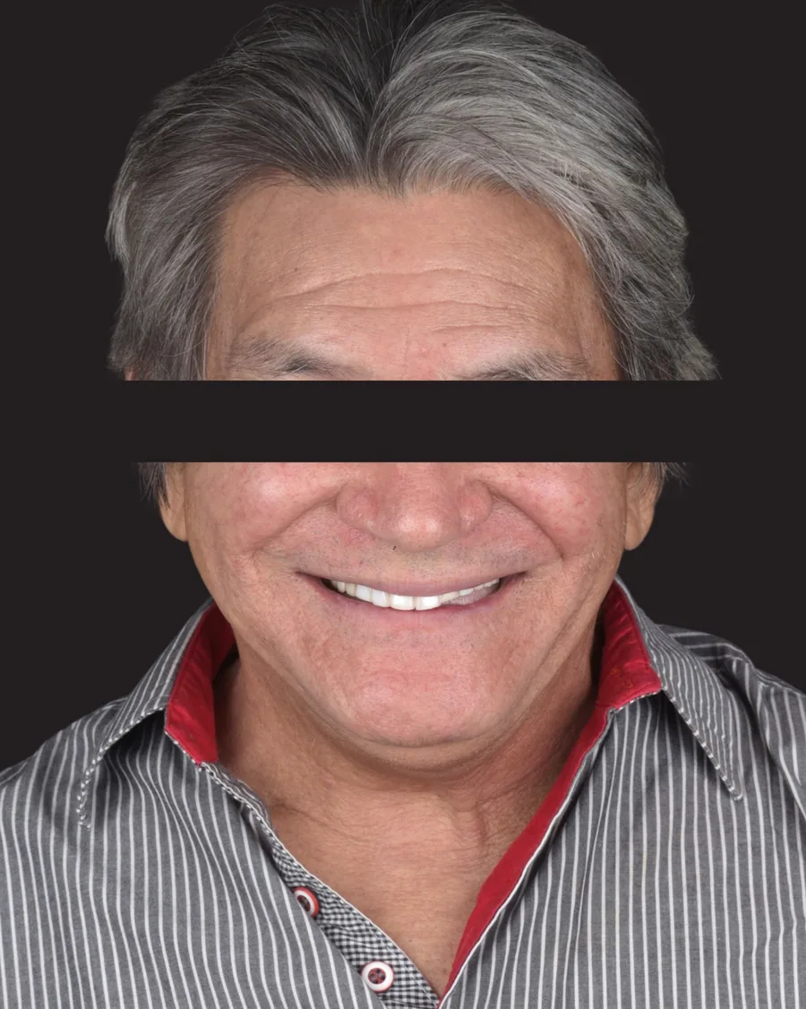 Antes